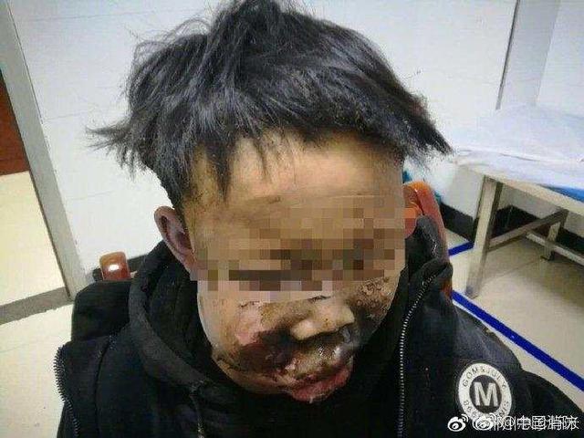 男孩玩鞭炮9级伤残,男童玩鞭炮手炸伤
